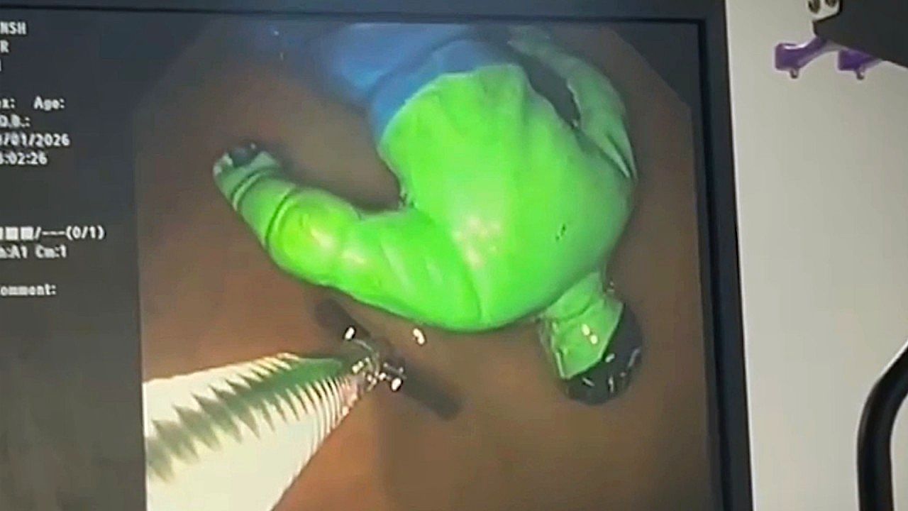 Video: Doctors remove huge surprise from an 18-month-old toddler's stomach