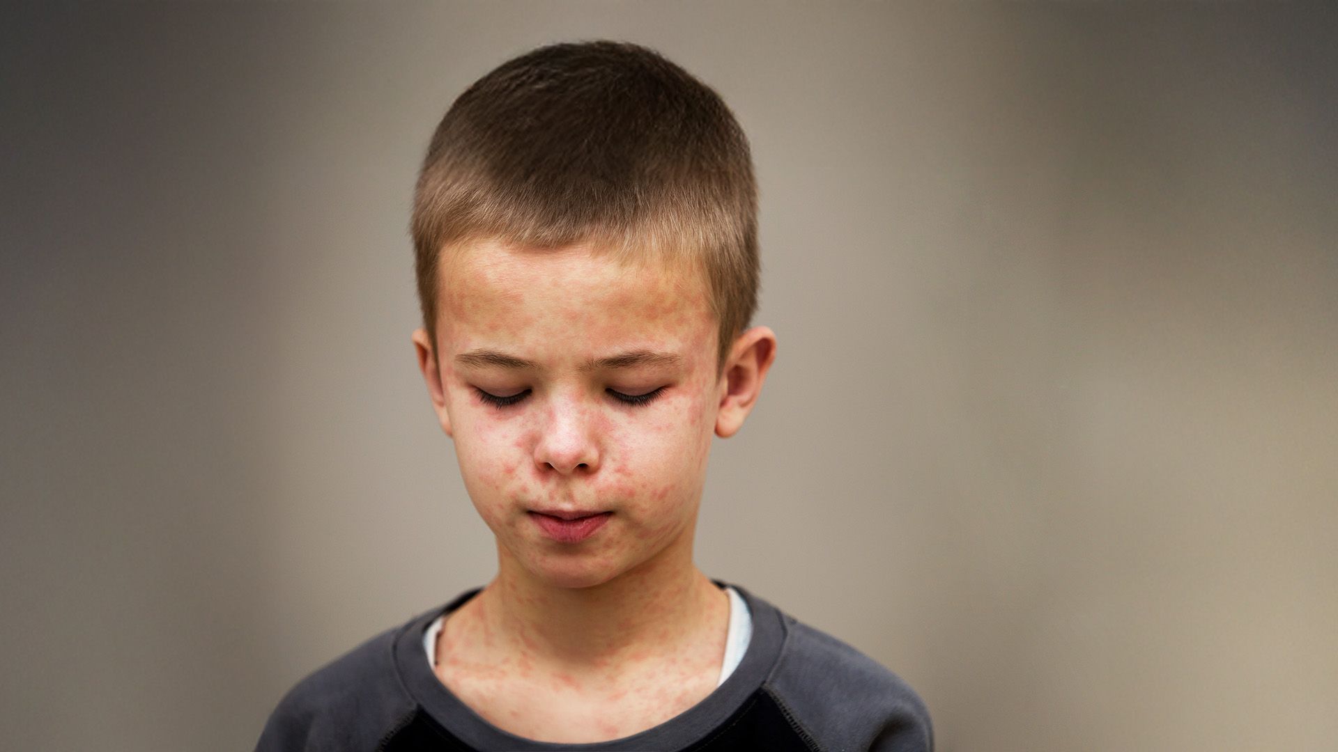 Video: Masern-Ausbruch in den USA: Bereits Tote