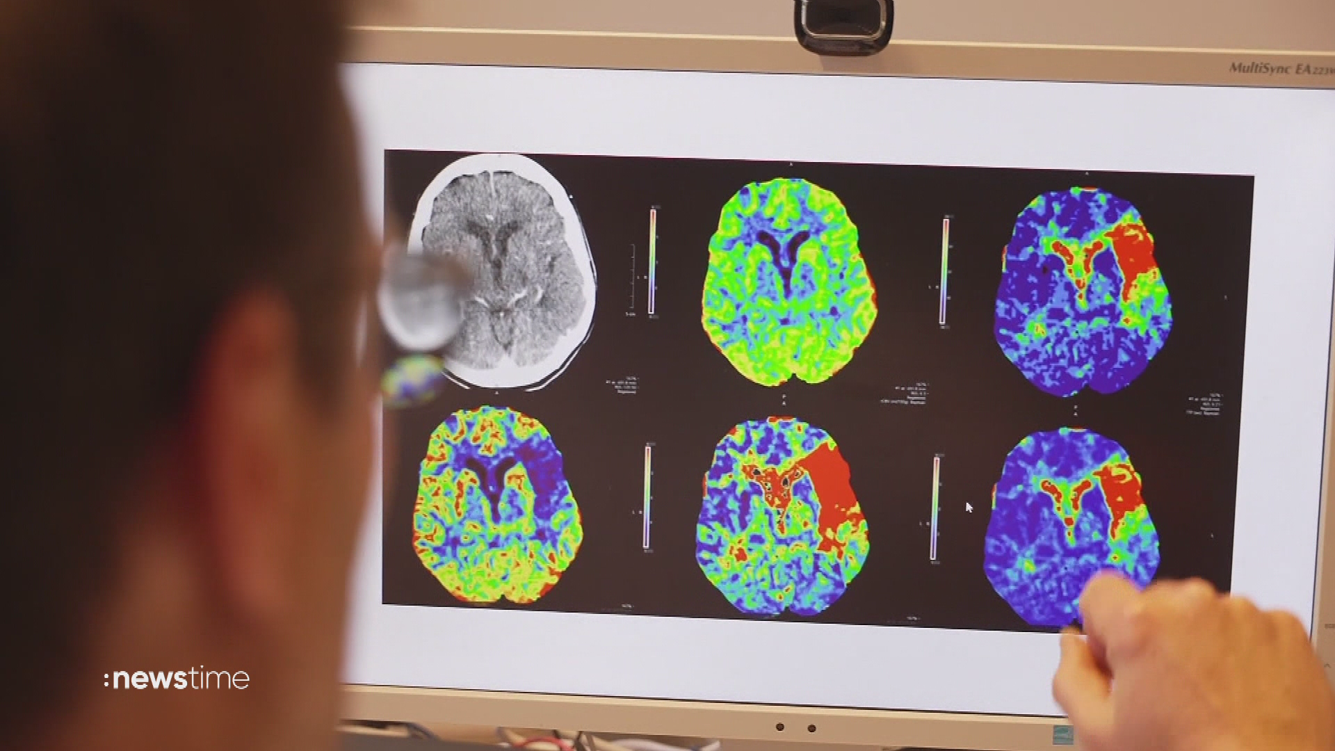 Video: Schlaganfall: Schnelle Hilfe rettet Leben