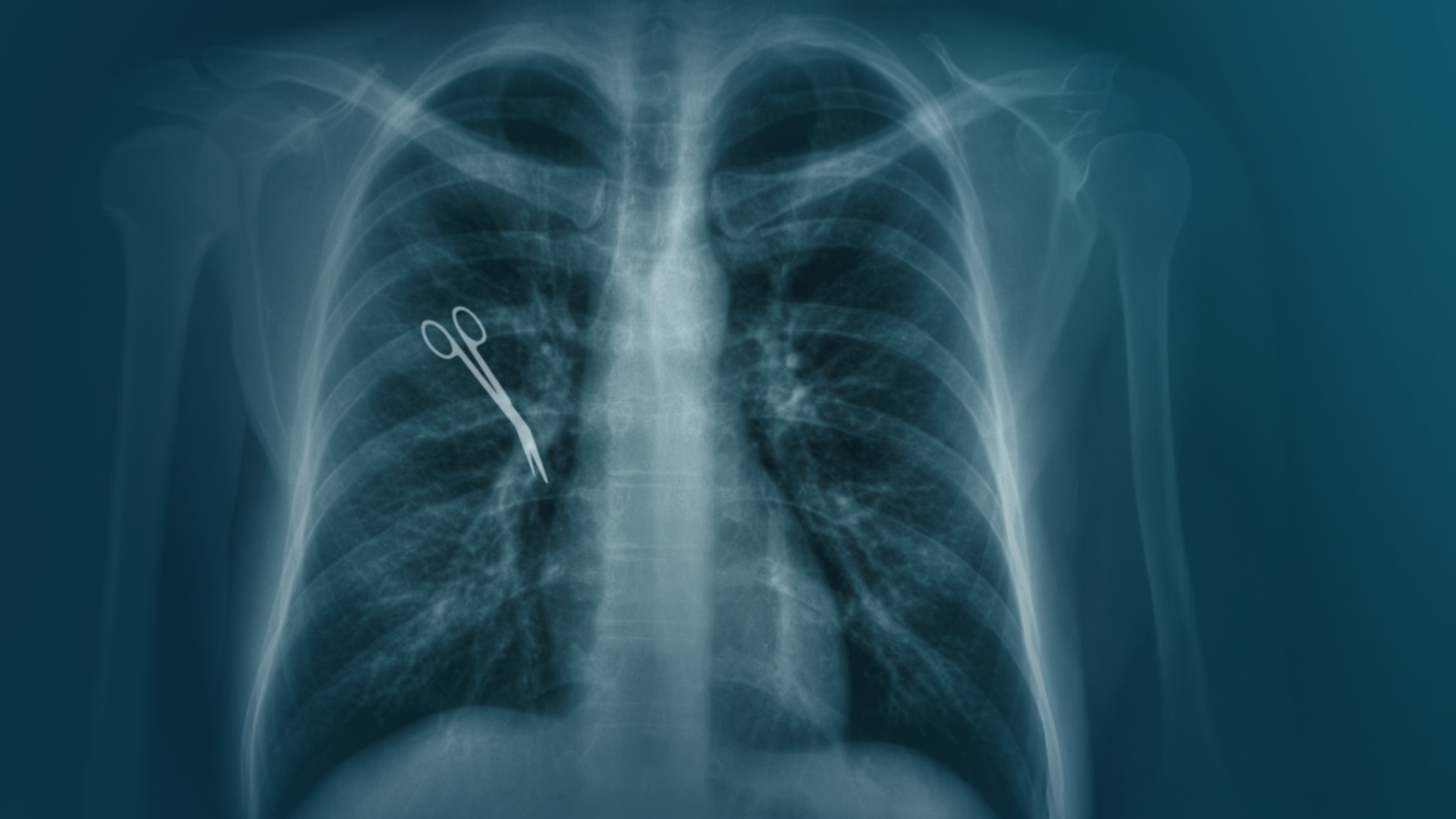 Video: Tausende OP-Behandlungsfehler pro Jahr